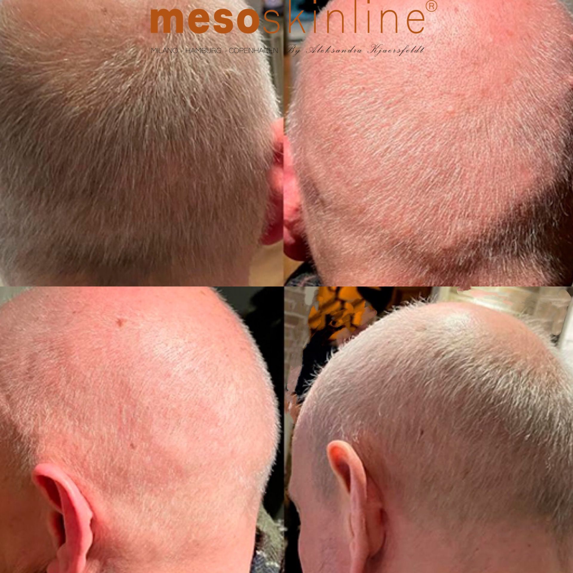 mesoskinline hair regrowth skin needling