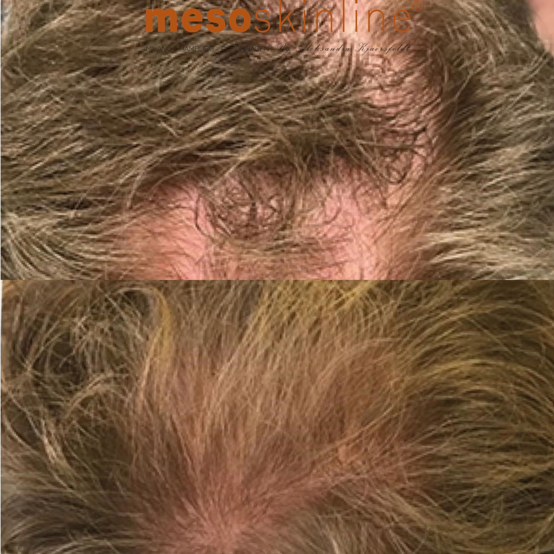 mesoskinline hair regrowth skin needling results