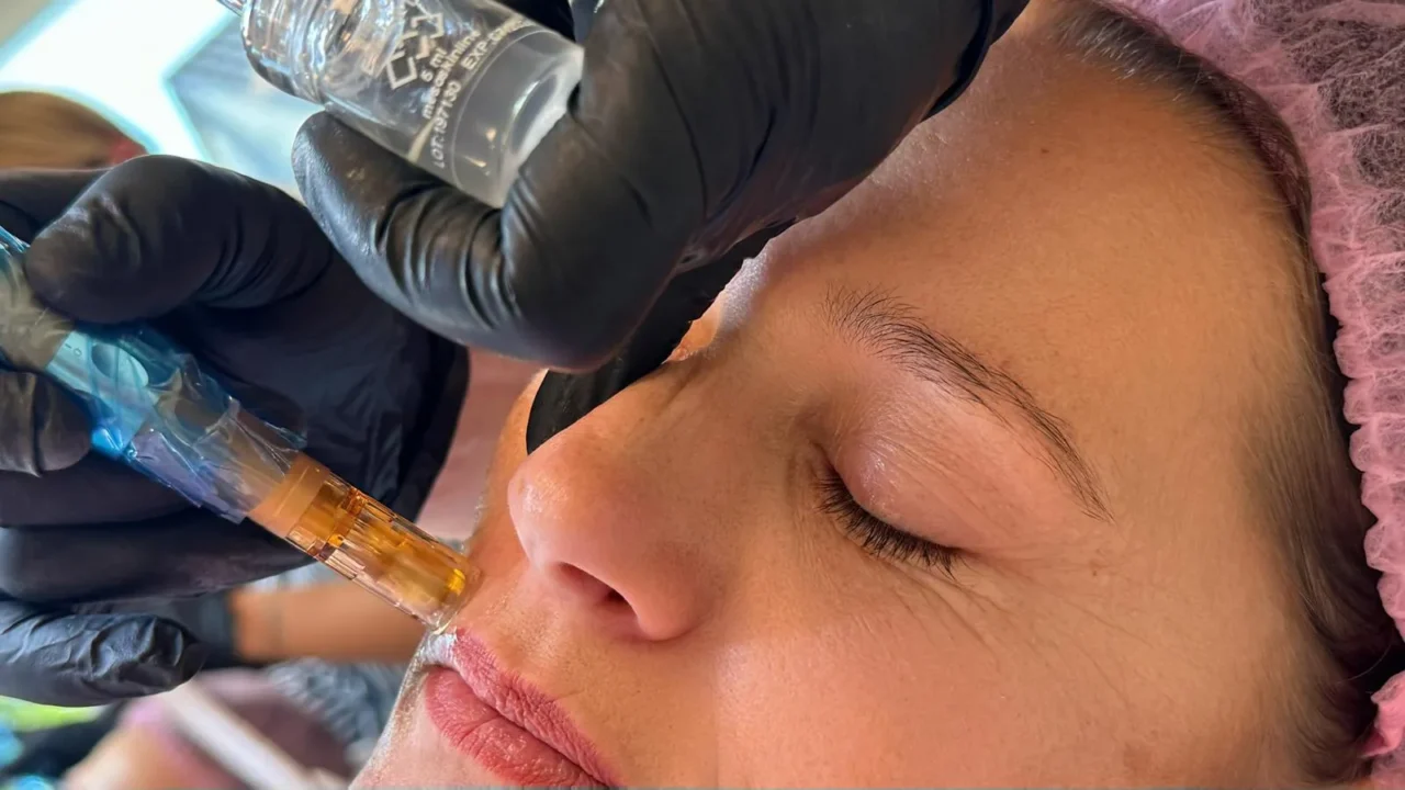 microneedling cocktails