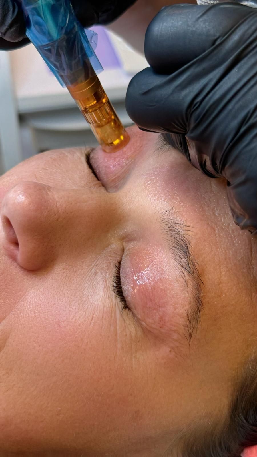 firming skin needling